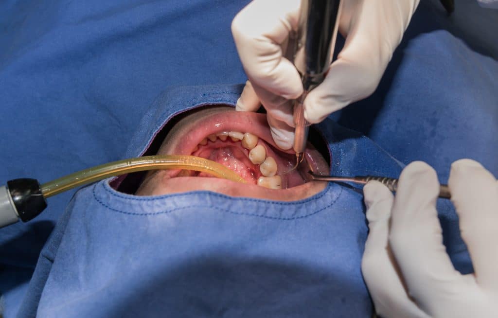 Root Canal Therapy Millersville