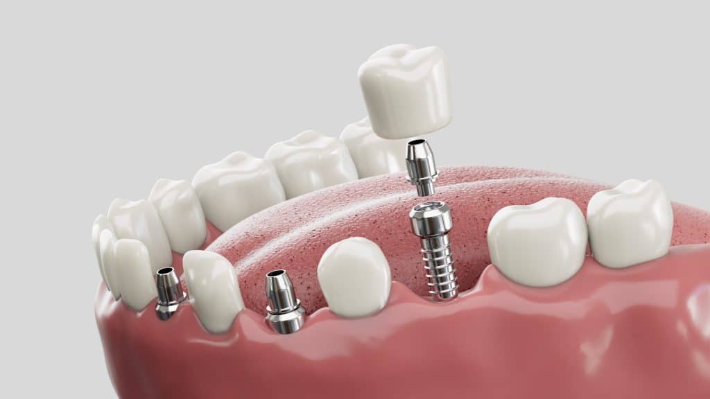dental implants millersville