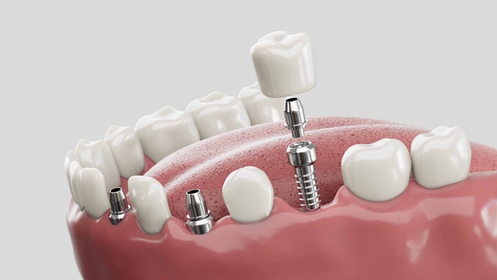 dental implants millersville