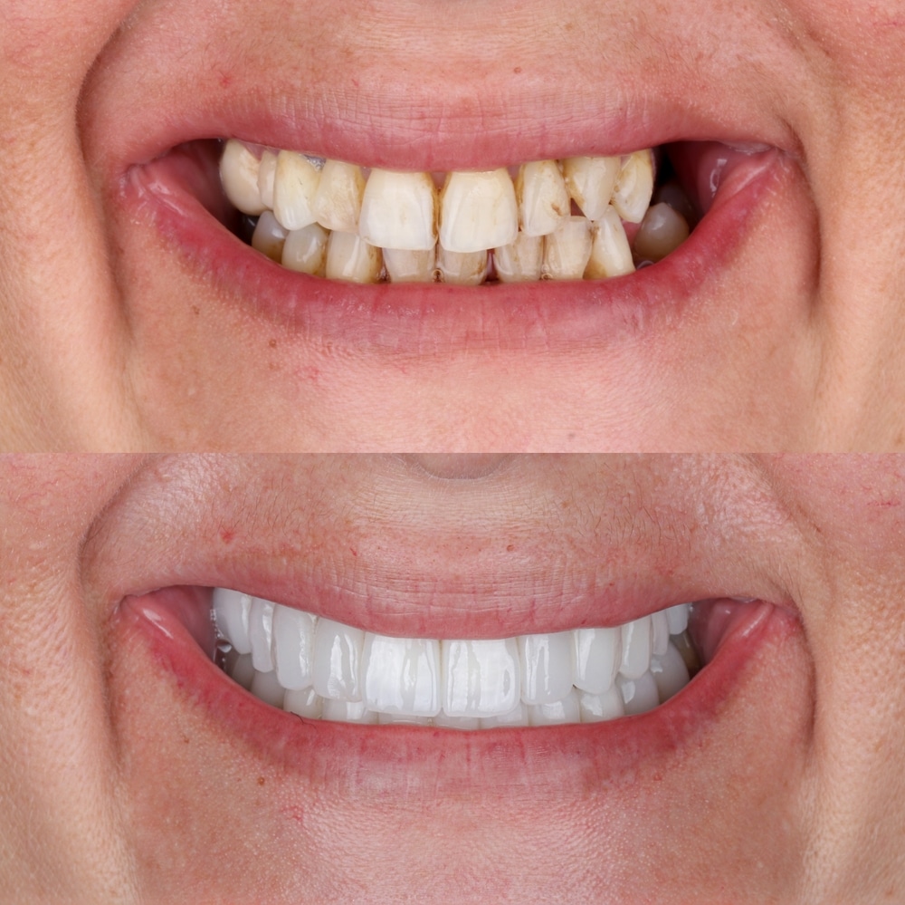 full mouth makeover millersville